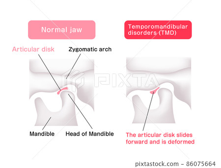 Difference between normal jaw and temporomandibular joint disease jaw / indirect disk Vector illustration (English) 86075664