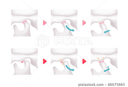Comparison vector illustration of normal jaw and temporomandibular joint disease jaw / jaw opening / closing (no text) 86075665