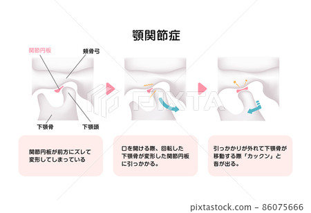 顳下頜關節紊亂病媒說明的機制和原因 86075666