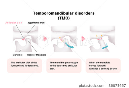 Mechanism and cause of temporomandibular disorders Vector illustration Mechanism and cause of temporomandibular disorders Vector illustration 86075667