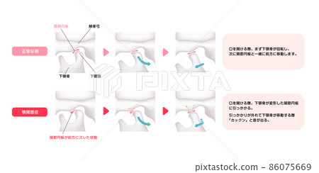 正常頜與顳下頜關節疾病頜/頜開閉的比較矢量圖解 86075669