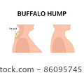 Patient with buffalo hump with fat deposits around the vertebrae. Dowager's hump, kyphosis, spine. For topics like post-menopause, osteoperosis, scoliosis  86095745