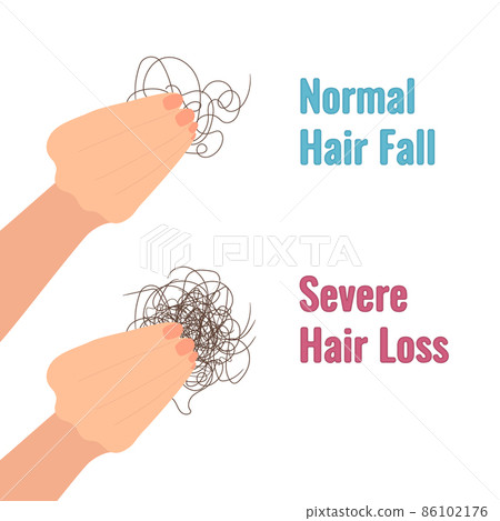 Hair shedding versus hair loss medical diagram - Stock Illustration  [86102176] - PIXTA