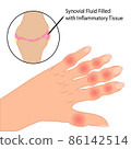 Rheumatoid arthritis on fingers medical vector illustration 86142514