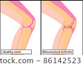 Healthy knee joint and Rheumatoid arthritis medical vector illustration 86142523