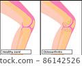 Healthy knee joint and osteoarthritis vector illustration 86142526