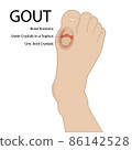 Gout arthritis. Human foot. Vector medical illustration. 86142528
