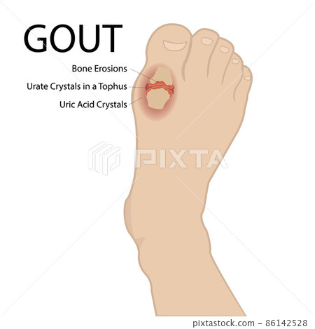 Gout arthritis. Human foot. Vector medical illustration. 86142528