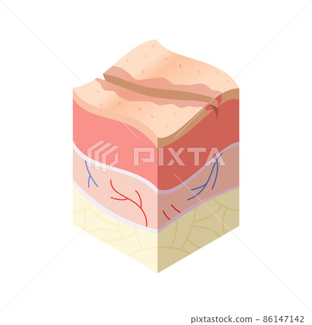 Skincare medical concept. Problems in cross-section of human skin horizontal layers structure. Anatomy illustrative model Skincare medical concept. Problems in cross-section of human skin horizontal layers structure. Anatomy illustrative model 86147142