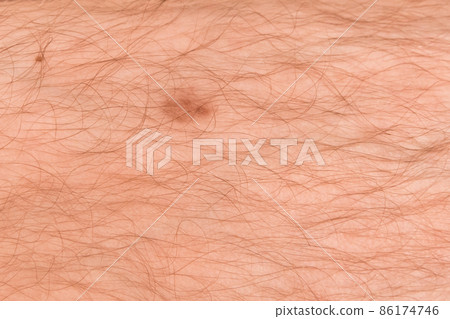 Red wound on the skin of a man's hairy leg, close-up Red wound on the skin of a man's hairy leg, close-up 86174746