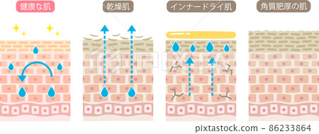 Cross section of skin Dry skin Inner dry Hyperkeratosis Healthy skin 86233864