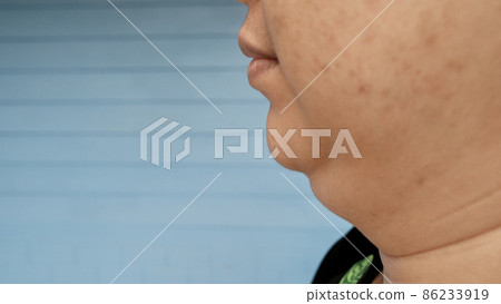 Fat lump under the chin of a woman overweight. Fat lump under the chin of a woman overweight. 86233919