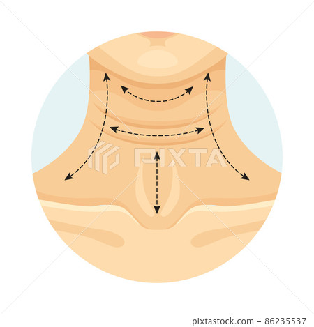 Cosmetic surgery on female neck with dotted lines. Platysmoplasty. Plastic surgery vector illustration Cosmetic surgery on female neck with dotted lines. Platysmoplasty. Plastic surgery vector illustration 86235537