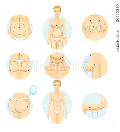 Plastic surgery set. Abdominoplasty, liposuction, buttocks and breast correction vector illustration Plastic surgery set. Abdominoplasty, liposuction, buttocks and breast correction vector illustration 86235550