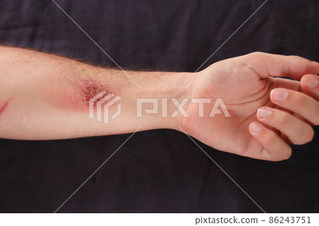Left hand suffering from skin abrasion injury against a black background Left hand suffering from skin abrasion injury against a black background 86243751