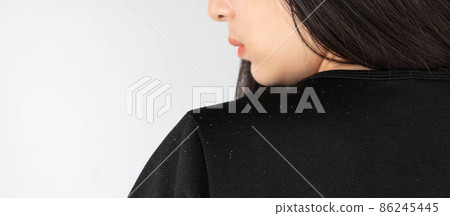Dandruff and seborrheic dermatitis problem. Long black hair woman looking at hair flakes on her shoulder. Hair care concept. Selective focus. Dandruff and seborrheic dermatitis problem. Long black hair woman looking at hair flakes on her shoulder. Hair care concept. Selective focus. 86245445