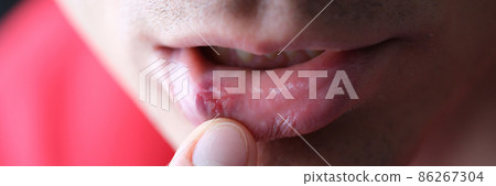 Herpes on male inner lip closeup. Symptoms and treatment of herpes Herpes on male inner lip closeup. Symptoms and treatment of herpes 86267304