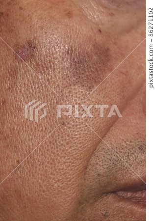 Large stains on the cheeks of an elderly man 1 86271102