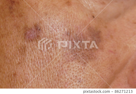 老人臉頰上有大塊污漬 4 老人臉頰上有大塊污漬 4 86271213