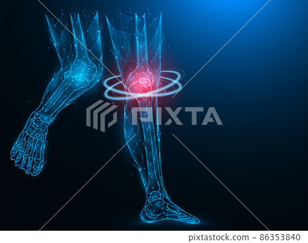 Polygonal vector illustration of human legs, painful and inflamed knee. Sick knee recovery concept. Treatment of knee arthritis. Futuristic medical banner, template or background. 86353840