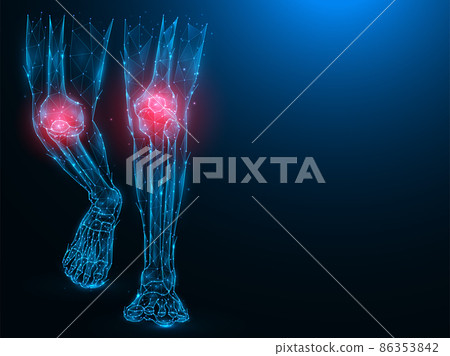 Polygonal vector illustration of human legs, painful and inflamed knees. Sick knees concept. Arthritis of the knee joints.. Medical banner, template or background. 86353842