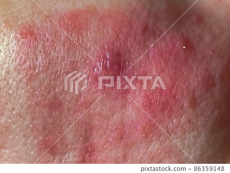 Close-up, selective focus, dermatological infection of the skin, in which redness and rashes on the skin of the face Close-up, selective focus, dermatological infection of the skin, in which redness and rashes on the skin of the face 86359148