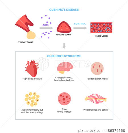 Cushing Desease poster 86374668