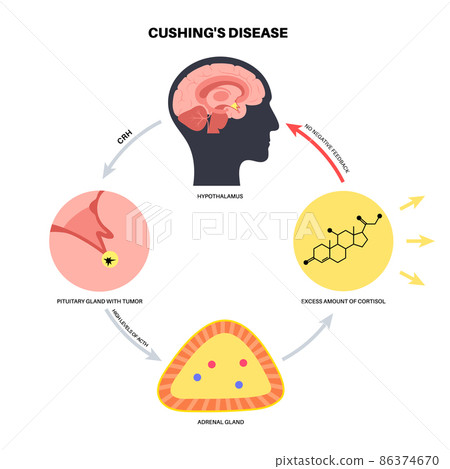 Cushing Desease poster 86374670