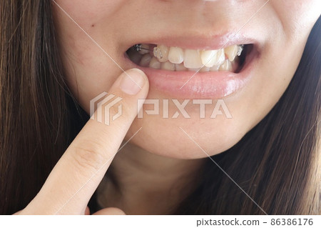 正在接受口腔正畸學的女性 86386176