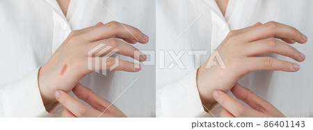 Close up of woman hands before and after treatment cream to removal burn scar. Dermatology and skin problems concept. Close up of woman hands before and after treatment cream to removal burn scar. Dermatology and skin problems concept. 86401143