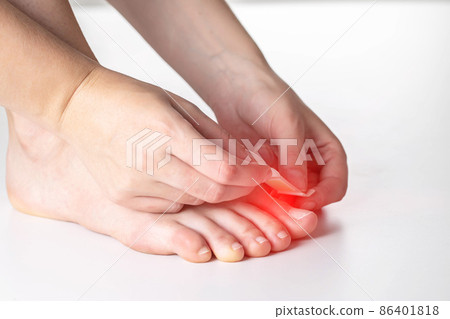 A woman glues a plaster for the treatment of calluses and calluses to her toe. Close-up A woman glues a plaster for the treatment of calluses and calluses to her toe. Close-up 86401818