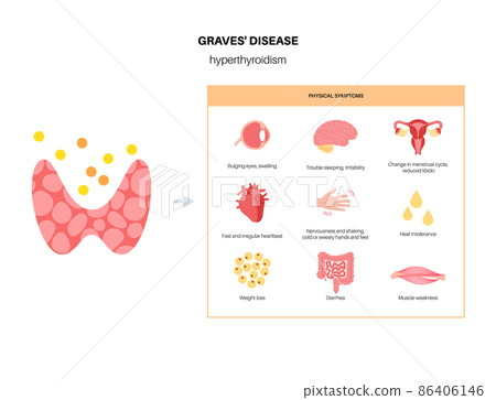 Graves desease symptoms 86406146