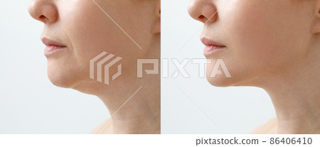 A close portrait of an aged woman before and after facial rejuvenation procedure. Correction of the chin shape liposuction of the neck. The result of the procedure in the clinic of aesthetic medicine. A close portrait of an aged woman before and after facial rejuvenation procedure. Correction of the chin shape liposuction of the neck. The result of the procedure in the clinic of aesthetic medicine. 86406410
