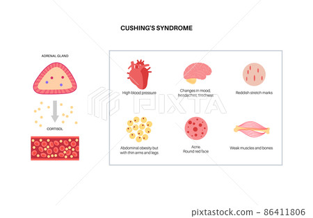 Cushing Desease poster 86411806