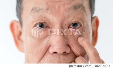 Senior male eyes cataract dry eye 86418683