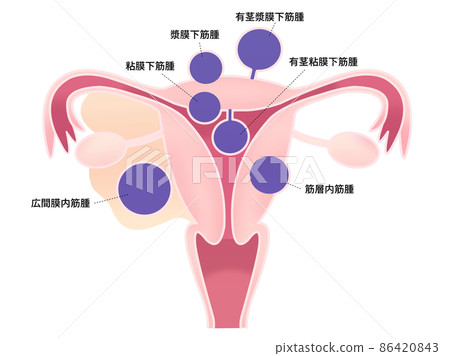 子宮肌瘤圖解(帶字母) 子宮肌瘤圖解(帶字母) 86420843