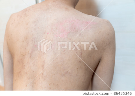 Image of atopy / heat rash / dermatitis. A photo of a man with rough skin. 86435346