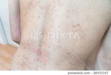 特應性/熱疹/皮炎的圖像。一張皮膚粗糙的男人的照片。 86435347