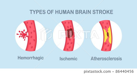 Types of human brain stroke. Ischemic, atherosclerosis and hemorrhagic stroke disease 86440456