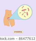Cystitis, bacterial infection of urinary bladder illustration. Female health, disease, urology. For topics like inflammation, diarrhea, diagnosis 86477612