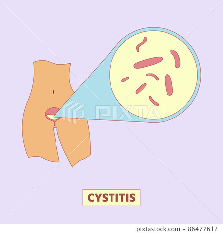 Cystitis, bacterial infection of urinary bladder illustration. Female health, disease, urology. For topics like inflammation, diarrhea, diagnosis 86477612