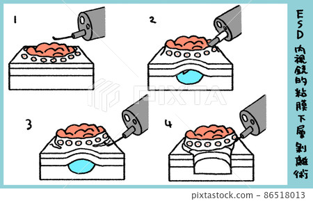 Endoscopic submucosal dissection ESD 86518013