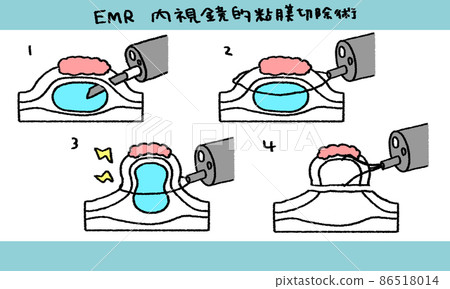 內鏡下黏膜切除術 86518014