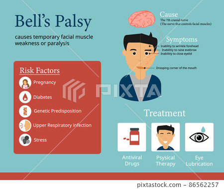 Bells palsy infographic to show the cause the symptom of it Bells palsy infographic to show the cause the symptom of it 86562257