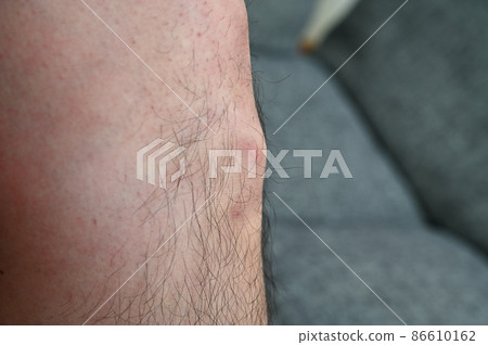 Osgood's disease Osgood-Schlatter's disease Growing pains knees and feet Osgood's disease Osgood-Schlatter's disease Growing pains knees and feet 86610162
