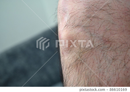 奧斯古德病 Osgood-Schlatter 病 膝蓋和腳的生長痛 奧斯古德病 Osgood-Schlatter 病 膝蓋和腳的生長痛 86610169