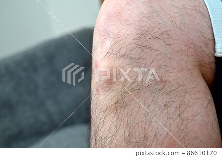 奧斯古德病 Osgood-Schlatter 病 膝蓋和腳的生長痛 奧斯古德病 Osgood-Schlatter 病 膝蓋和腳的生長痛 86610170