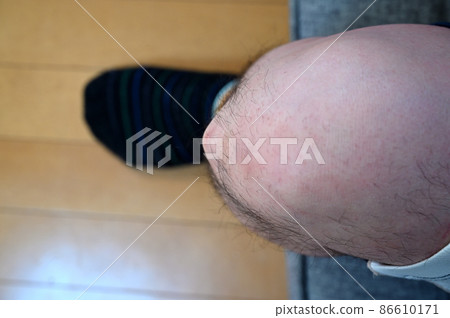 奧斯古德病 Osgood-Schlatter 病 膝蓋和腳的生長痛 奧斯古德病 Osgood-Schlatter 病 膝蓋和腳的生長痛 86610171