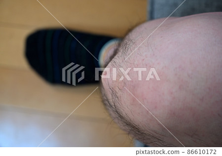 奧斯古德病 Osgood-Schlatter 病 膝蓋和腳的生長痛 奧斯古德病 Osgood-Schlatter 病 膝蓋和腳的生長痛 86610172