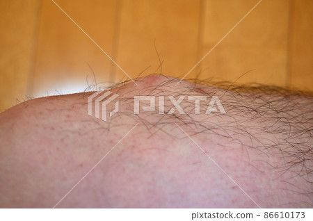 奧斯古德病 Osgood-Schlatter 病 膝蓋和腳的生長痛 奧斯古德病 Osgood-Schlatter 病 膝蓋和腳的生長痛 86610173